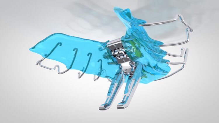 Effiziente Behandlung von Klasse II Fehlstellungen: