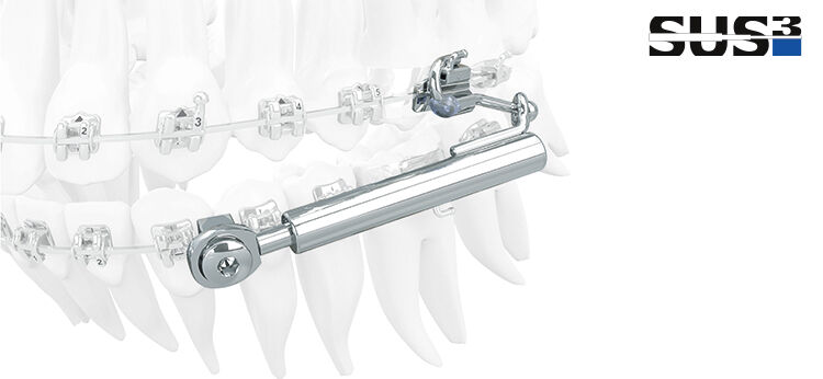 SUS³ – Sabbagh Universal Spring – la troisième génération