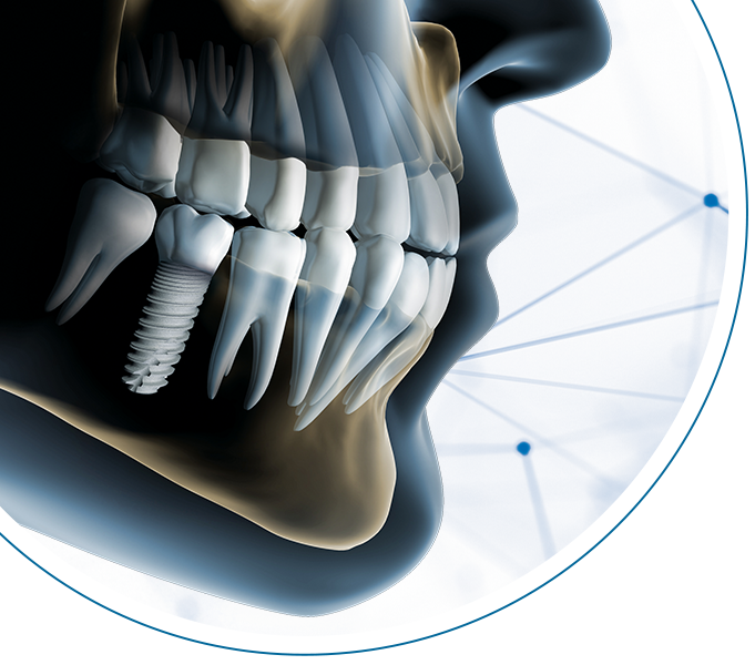 زراعة الأسنان الرقمية