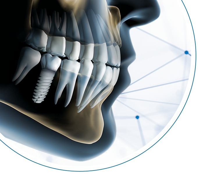 Digitale Implantologie