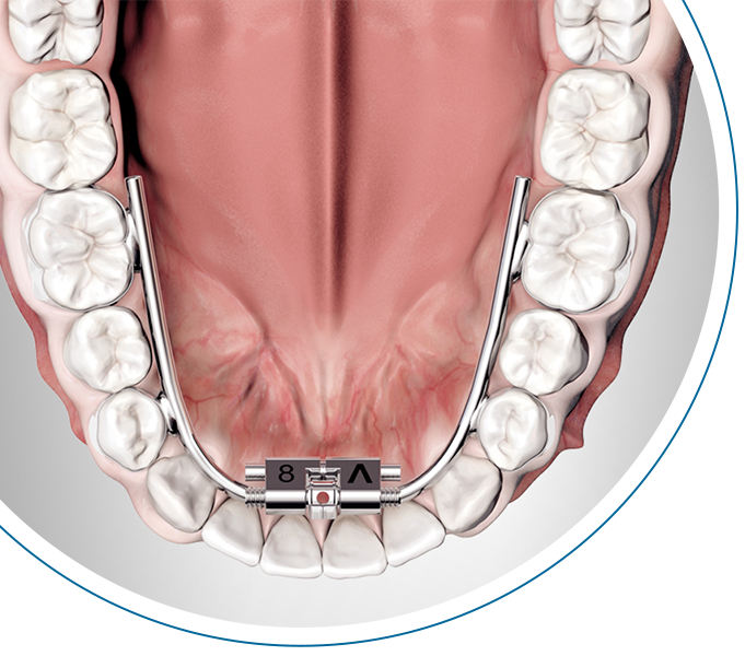 Tornillos de expansión RPE