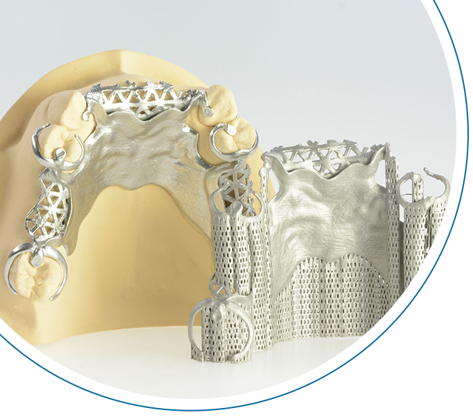 Digital cast partial dentures