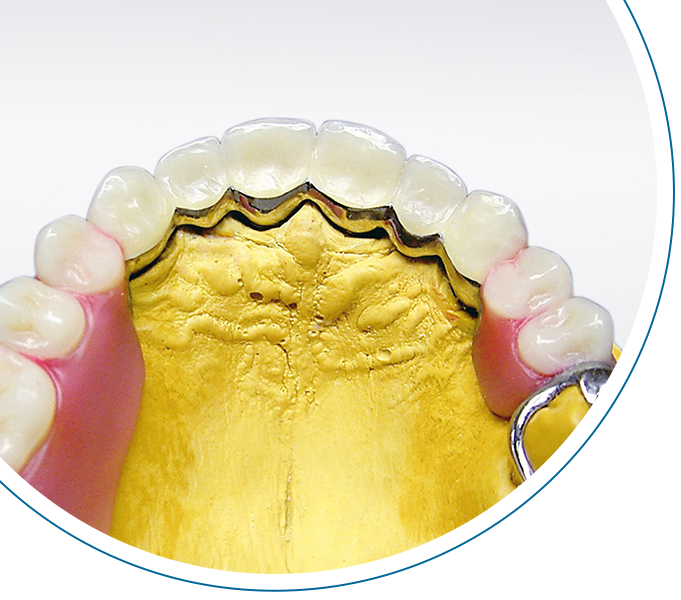 Combined prosthetic restorations