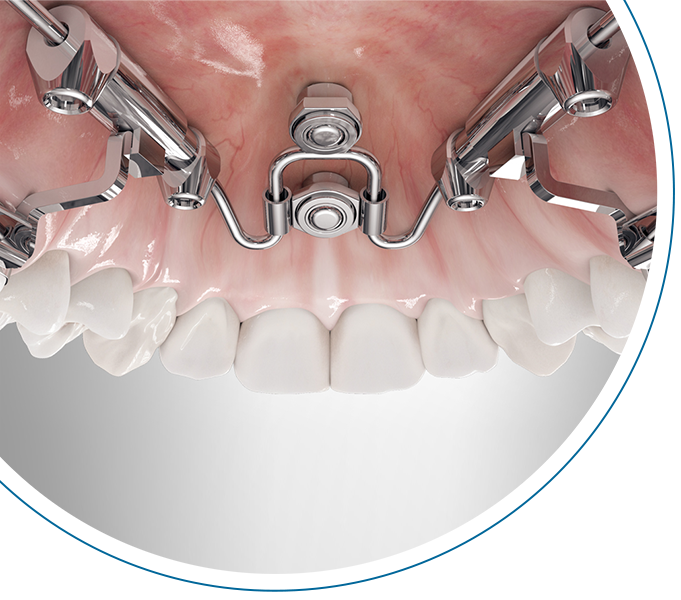 amda (advanced molar distalization appliance)