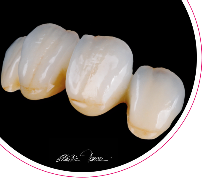 ceraMotion® Veneering ceramics