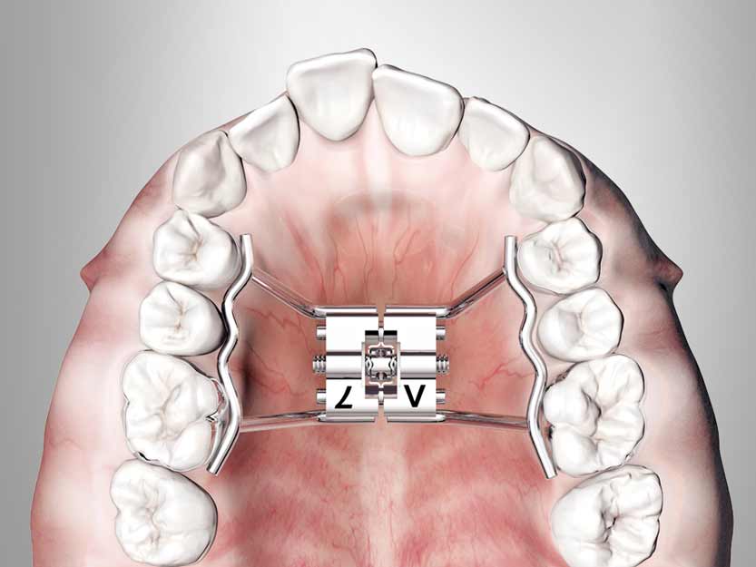 RPE expansion screws