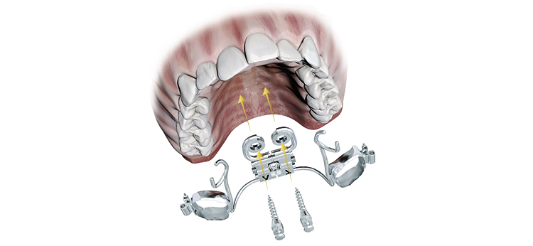 The new tomas®-RPE eyelet for hybrid RPE and MARPE